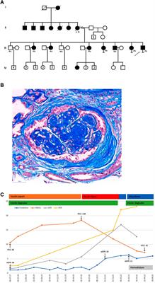 Severe nephrotic syndrome and early end-stage diabetic kidney disease in ABCC8-MODY12: A case report